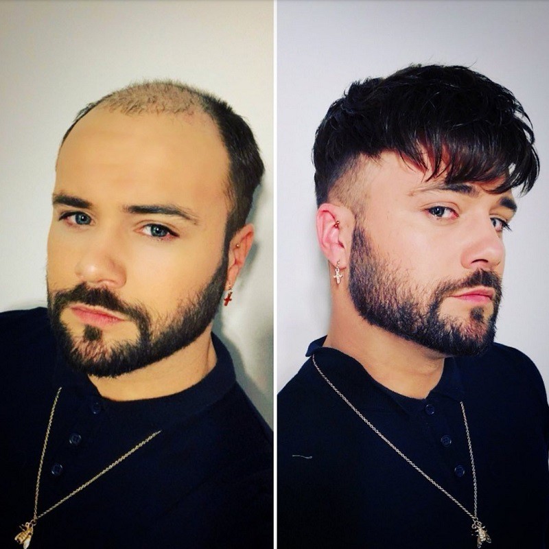 Oceanus Männerhaarsystem | Spitze vorne, Haut im Rücken | LaVividHair