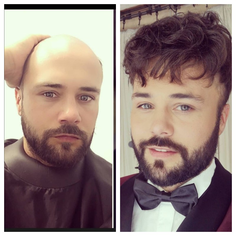 Achilles Vollhautbasis Haareinheit für Männer | LaVividHair