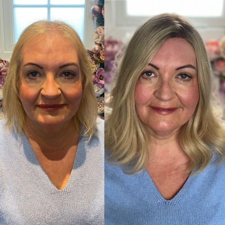 Taylor Damen Haa|Nicht-chirurgische Lösung für dünner werdendes Haar